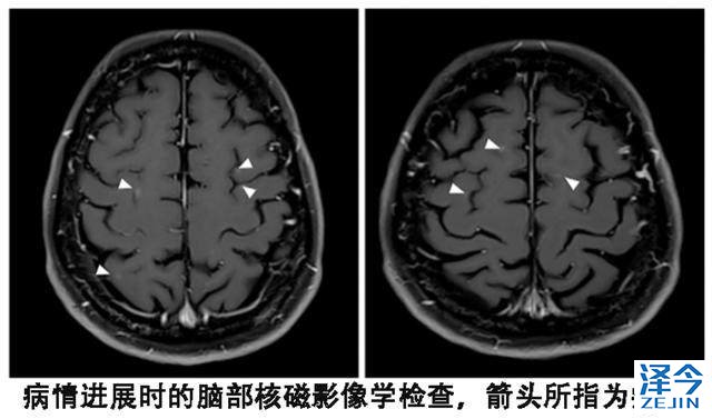 泰瑞沙（AZD9291）