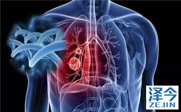 第3代EGFR TKI靶向药AZD9291克服1代耐药