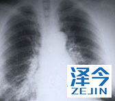 易瑞沙治疗肺癌跟化疗的效用一样吗？