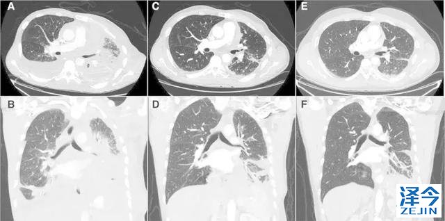 2019非小细胞肺癌患者将有哪些全新的治疗方案？