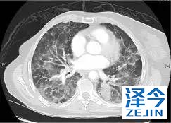 史上最全！肺癌靶点全面解读及对应靶向药物方案盘点！（2018）