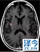 史上最全！肺癌靶点全面解读及对应靶向药物方案盘点！（2018）