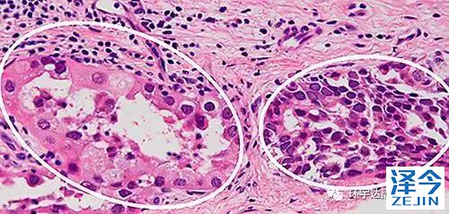 不可思议，肺腺癌患者吃了这种靶向药居然变成了小细胞肺癌！