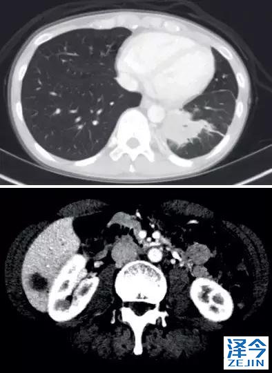 2019非小细胞肺癌患者将有哪些全新的治疗方案？