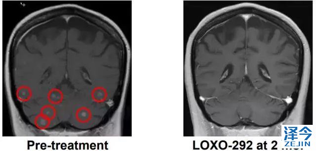 2018，两款重磅新药给RET基因融合的癌症患者带来春天！