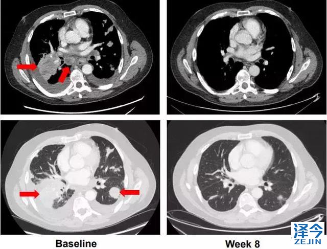 2018，两款重磅新药给RET基因融合的癌症患者带来春天！