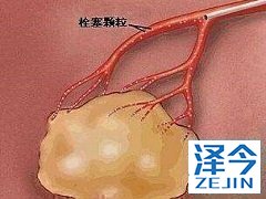 关于乐伐替尼的定量分析