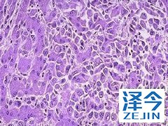 乐伐替尼可以治疗分化型甲状腺癌