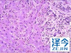 乐伐替尼治疗难治性甲状腺癌的综述