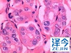 乐伐替尼与依维莫司的联合用药治疗转移性肾癌