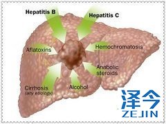 乐伐替尼治疗我国HCC肝癌患者更加有效！