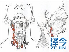 乐伐替尼是一种活性小分子激酶抑制剂