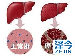 乐伐替尼对于肝癌患者的肝腹水是否有效？