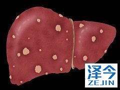 乐伐替尼在肝癌中的作用