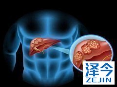 乐伐替尼与索拉非尼的对比