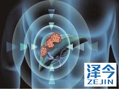 乐伐替尼对于初诊肝细胞癌的治疗效果。