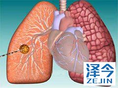 阿法替尼服用5周后成功将肺部肿瘤缩小60%