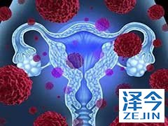 尼拉帕尼为什么可以治疗卵巢癌?