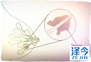 帕博西尼（palbociclib）治疗乳腺癌