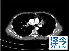 对埃罗替尼耐药的肺癌患者使用奥希替尼有效吗