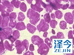 奥希替尼在EGFR突变NSCLC患者中受益