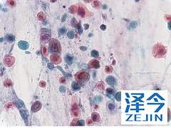 奥希替尼治疗非小细胞肺癌患者的间质性肺病