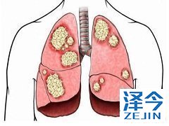 奥希替尼治疗突变的非小细胞肺癌获认可
