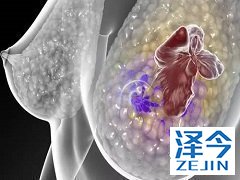 来那替尼改善HER2阳性乳腺癌的5年DFS