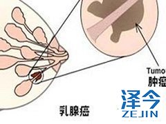 来那替尼联合T-DM1治疗HER2阳性乳腺癌ORR为60%