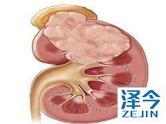 卡博替尼联合治疗癌症效果如何