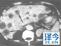 卡博替尼在肾癌放射抗性脑转移中的活性