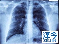 发生脑转移肺癌患者的可使用布加替尼