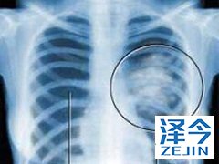 使用布加替尼与克唑替尼会出现不良反应吗