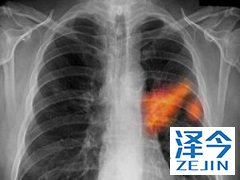 布加替尼针对脑复发的ALK患者有治疗效果