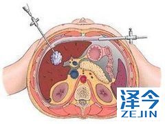吉三代治疗失代偿期肝硬化患者的HCV