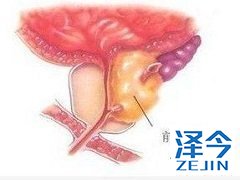 阿比特龙联合化疗有副作用吗？