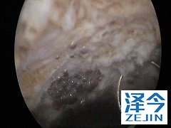 阿比特龙治疗时加入泼尼松能降低副作用吗？