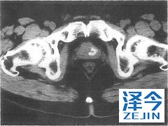 轻度肝受损的患者无需更改阿比特龙剂量