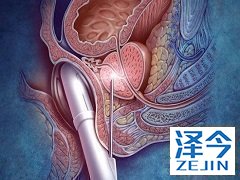 使用阿比特龙治疗癌症生存期优于其他实体瘤