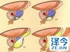 阿比特龙能减少患者的癌痛吗？