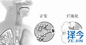 尼达尼布登陆中国,肺纤维化患者还是选择海外买