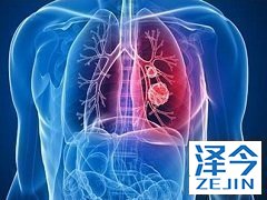 尼达尼布可增加肺纤维化患者的用力肺活量