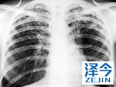 特发性肺纤维患者可以使用尼达尼布进行治疗吗