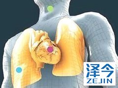 尼达尼布组获得肺功能改善的患者数量是安慰剂组的两倍