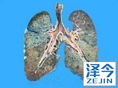 肺纤维化患者能够使用尼达尼布吗?