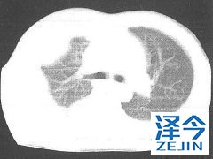 恶性胸膜间皮瘤