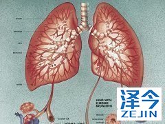 尼达尼布的对于IPF的治疗