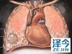 尼达尼布是一种抗纤维化药物