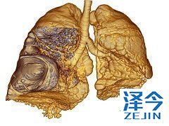 使用尼达尼布前后都需要进行血液检测