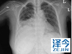 尼达尼布与化疗联合治疗效果更好